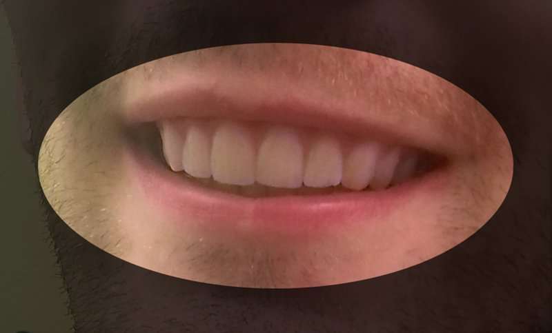 Acest tip şi-a reparat dinţii prin imprimarea 3D a propriului aparat ortodontic